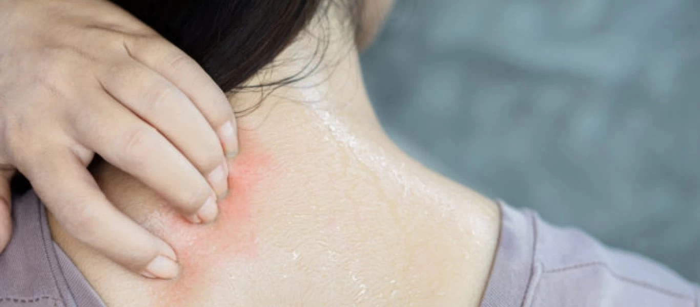 Οι υψηλές θερμοκρασίες μπορεί να έχουν επιπτώσεις στο δέρμα - Τι πρέπει να γνωρίζετε